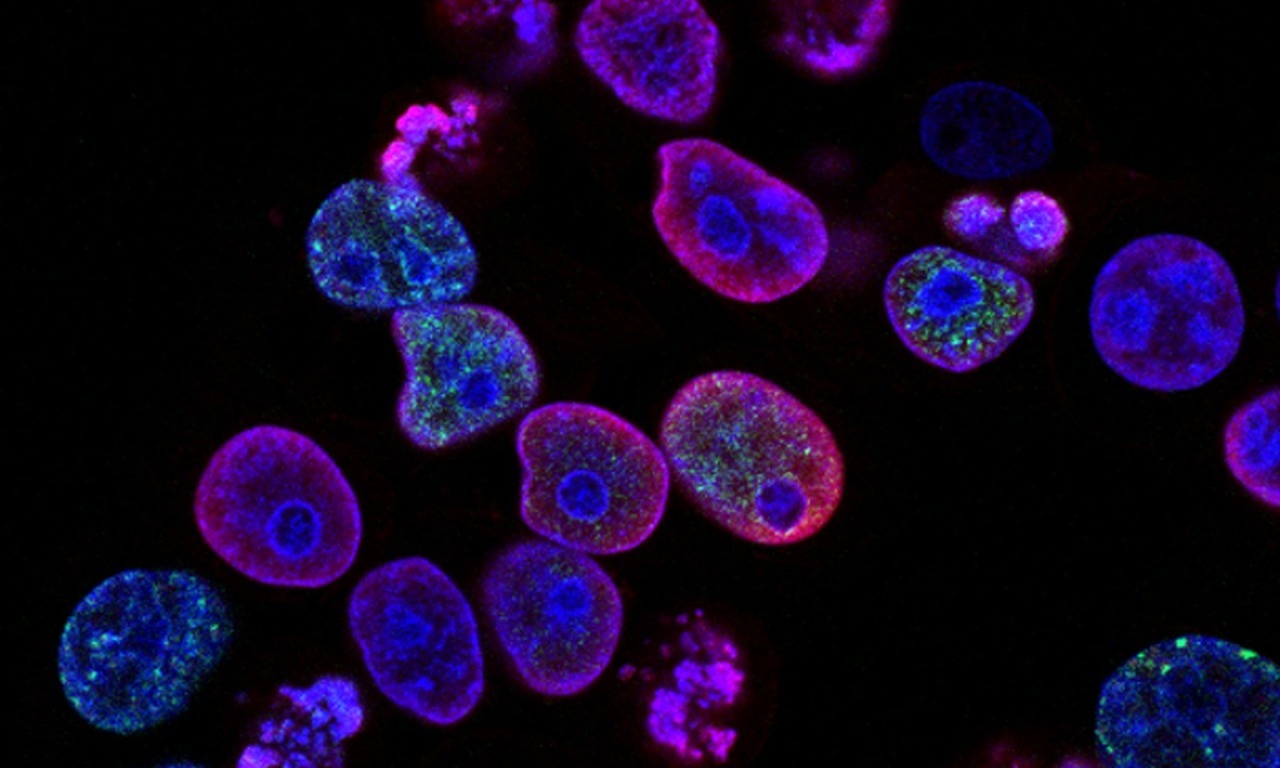Lotta al cancro: la biotecnologia, dalla cellula al paziente